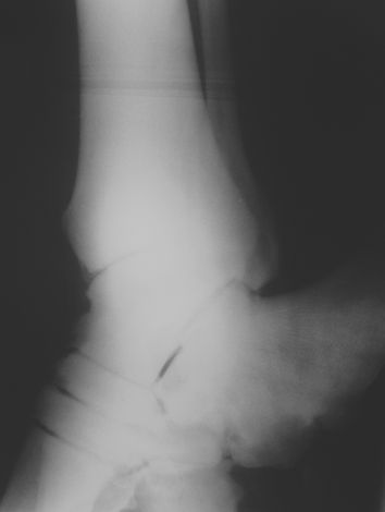 Radiograph of the tarsus of a 21 yr-old Asian elephant with degenerative joint disease involving multiple joints. Exostosis and reduced joint space can be seen.