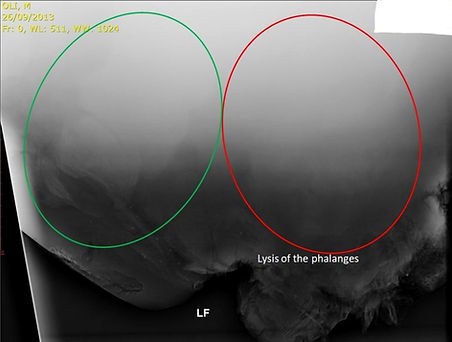 Radiographic image of a pododermatitis and osteolysis in an adult Asian elephant bull