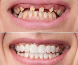 dental implant 
happy smiles dental