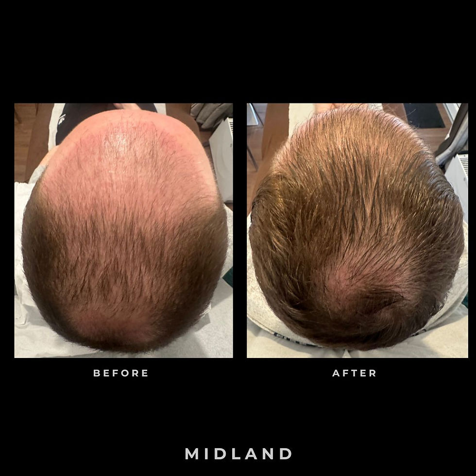Before and after PRP hair treatment showing reduced hair thinning