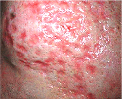 Aphrodite Acne.png