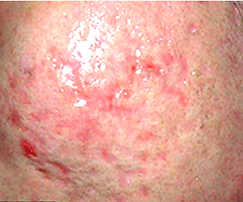 Aphrodite Acne.png