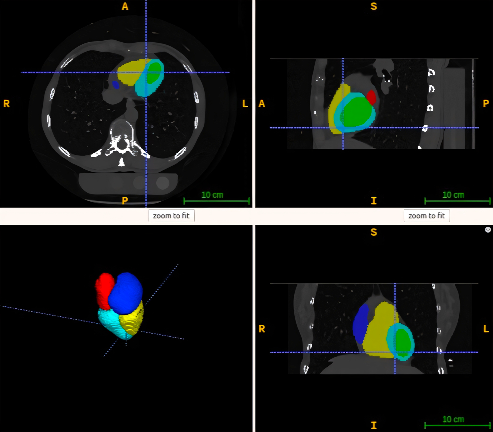 AI-Enhanced CT Screening