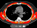 03c_Myosteatosis.png