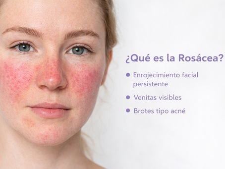Una chica con rosácea y un texto explicativo