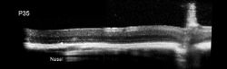 A-Examples-of-the-hyperreflective-vitreous-opacities-seen-in-rd10-mice-Presumably_edited