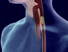 Oesophagus.gif