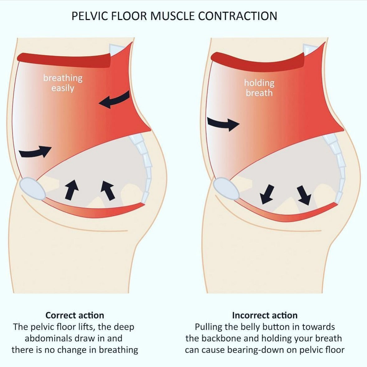 Diastasis recti and pelvic floor Print out