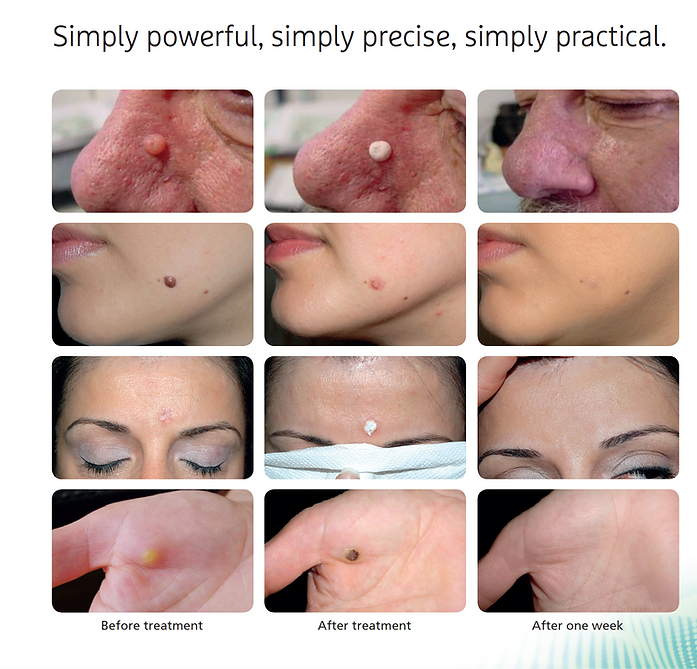 skin tag
