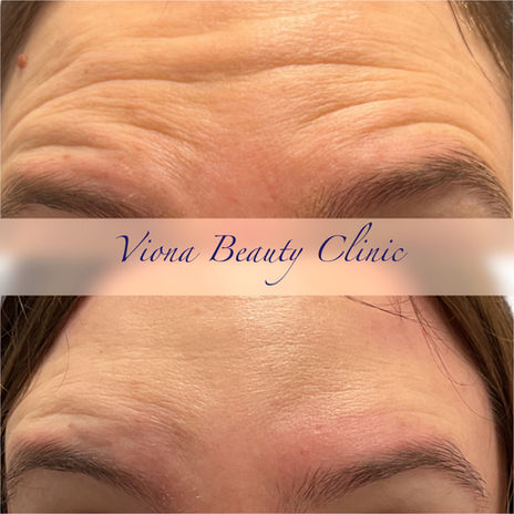 Anti Wrinkle Injection