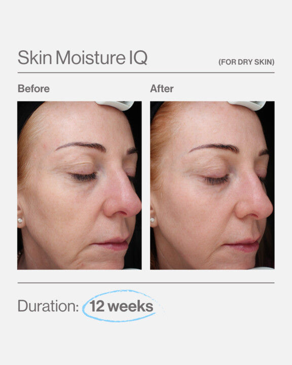 Thumbnail: Skin Moisture IQ