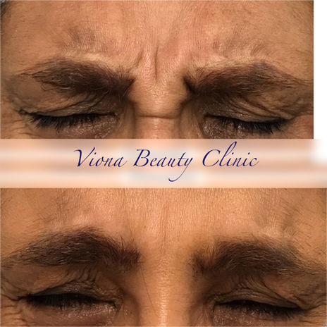 Anti Wrinkle Injection