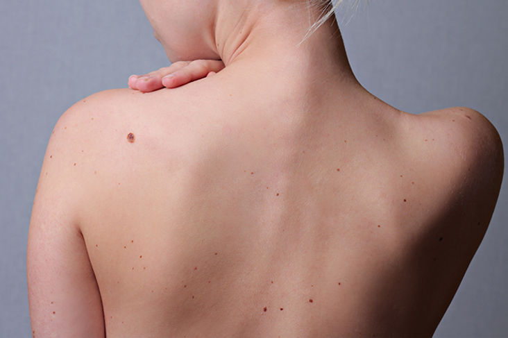 Cherry Angioma Removal.jpeg
