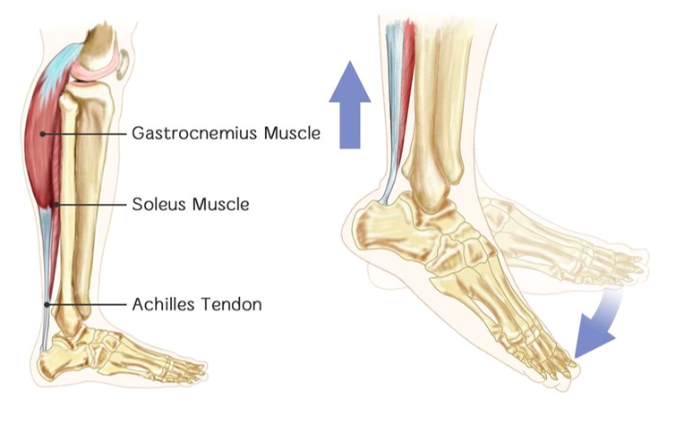 Best Shoes for Achilles Tendinopathy