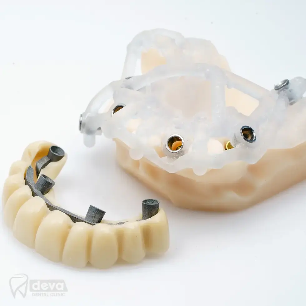 İzmir  All on Four İmplant Tedavisi 