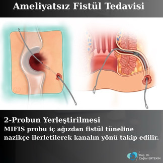kuyruk sokumunda fistül
