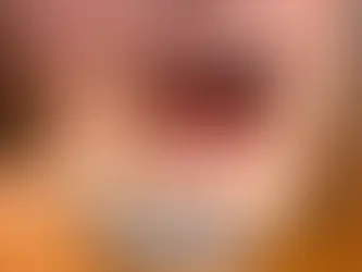 Diş Çekimi Sonrası Pıhtı Ne Zaman Düşer?