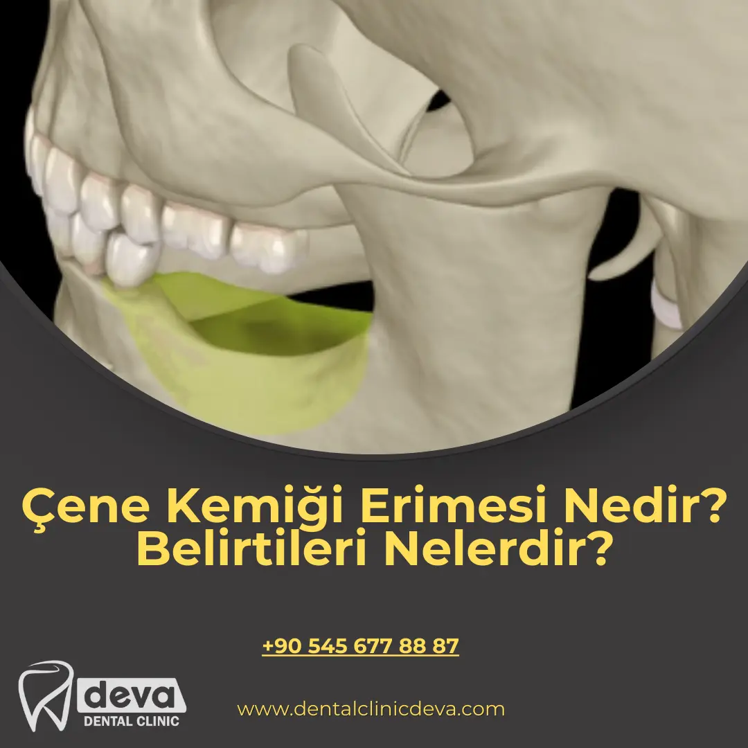 kanal tedavisi sonrası yanakta şişme kadınlar kulübü