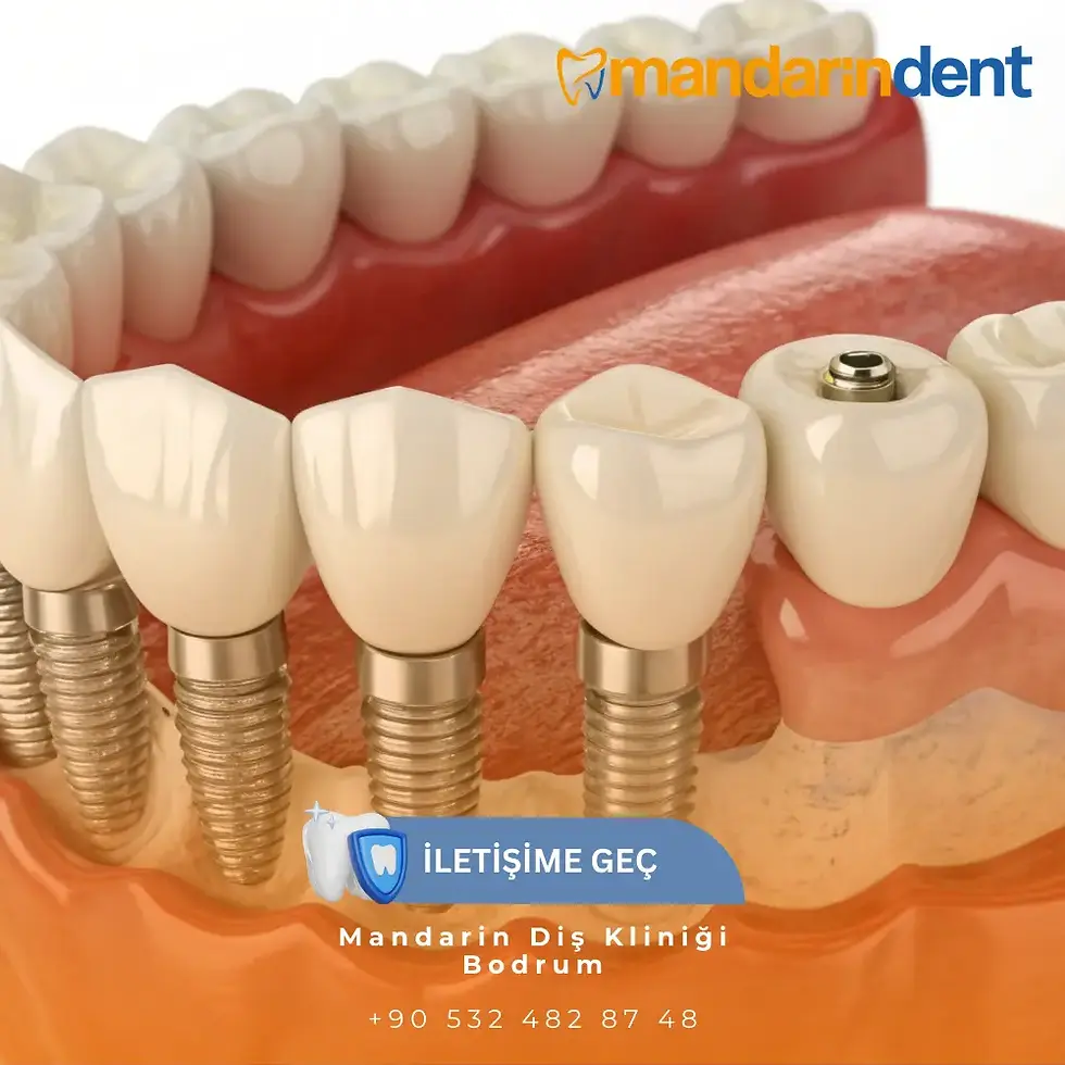Bodrum All on Six Diş İmplant, Bodrum En İyi İmplant Kliniği