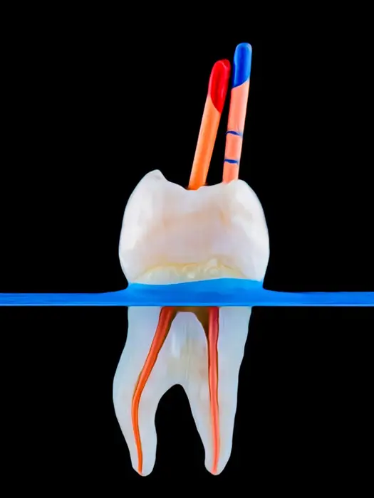 Bodrum Kanal Tedavisi