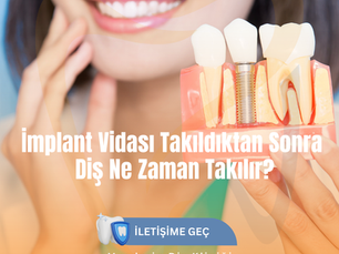 İmplant Vidası Sonrası Diş Ne Zaman Takılır?