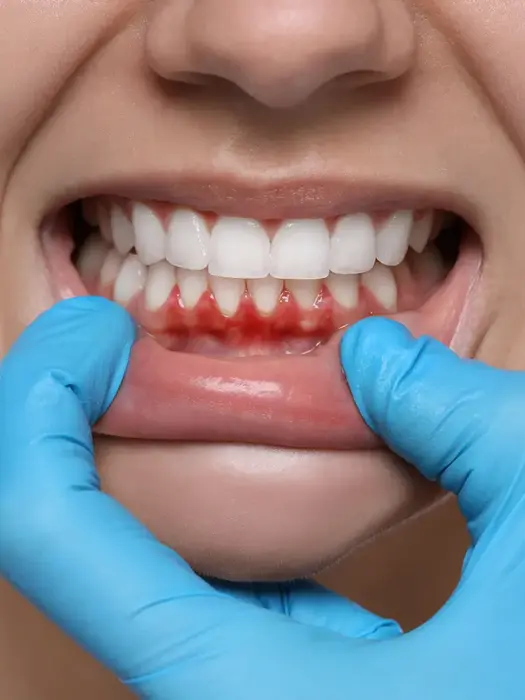 Bodrum Diş Eti Hastalıkları ve Tedavileri (Periodontoloji)