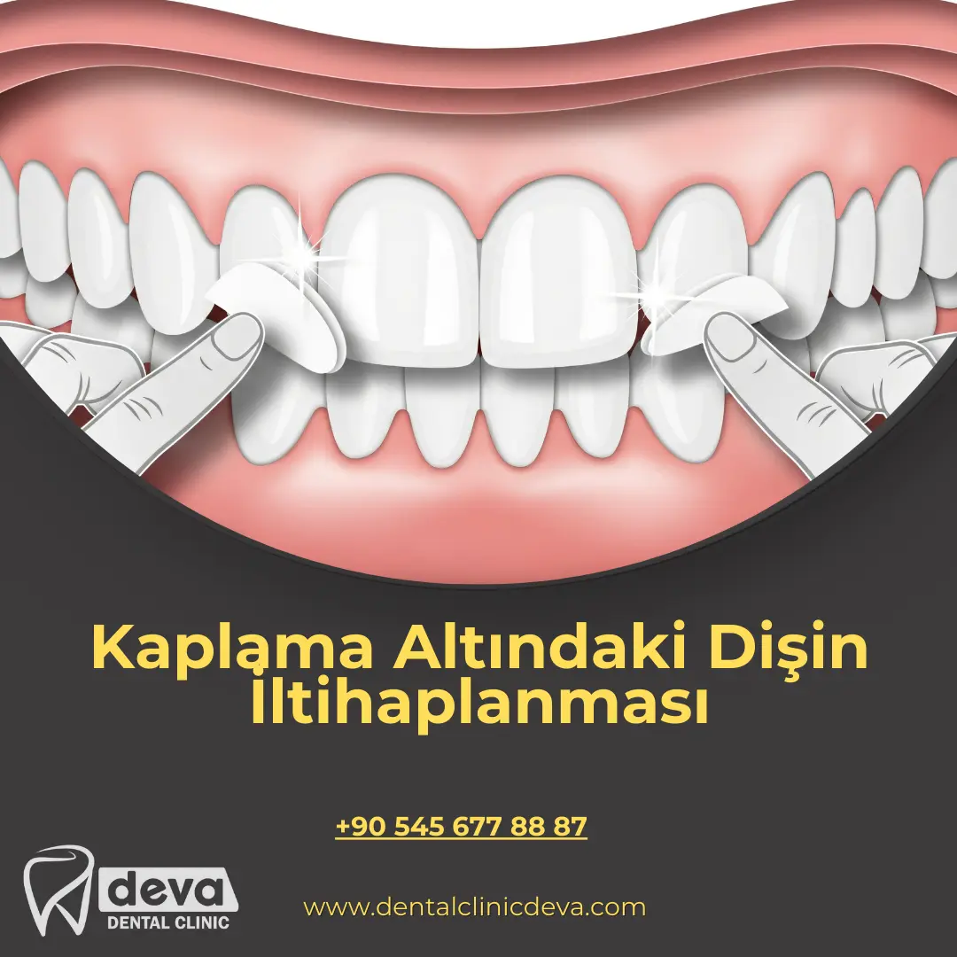 alveolit görüntüsü