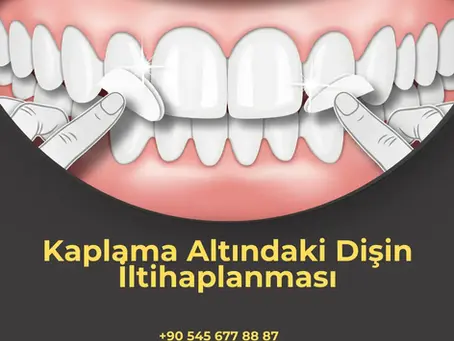 Kaplama altındaki dişin iltihaplanması belirtileri, nedenleri ve tedavi yöntemleri hakkında bilgi.