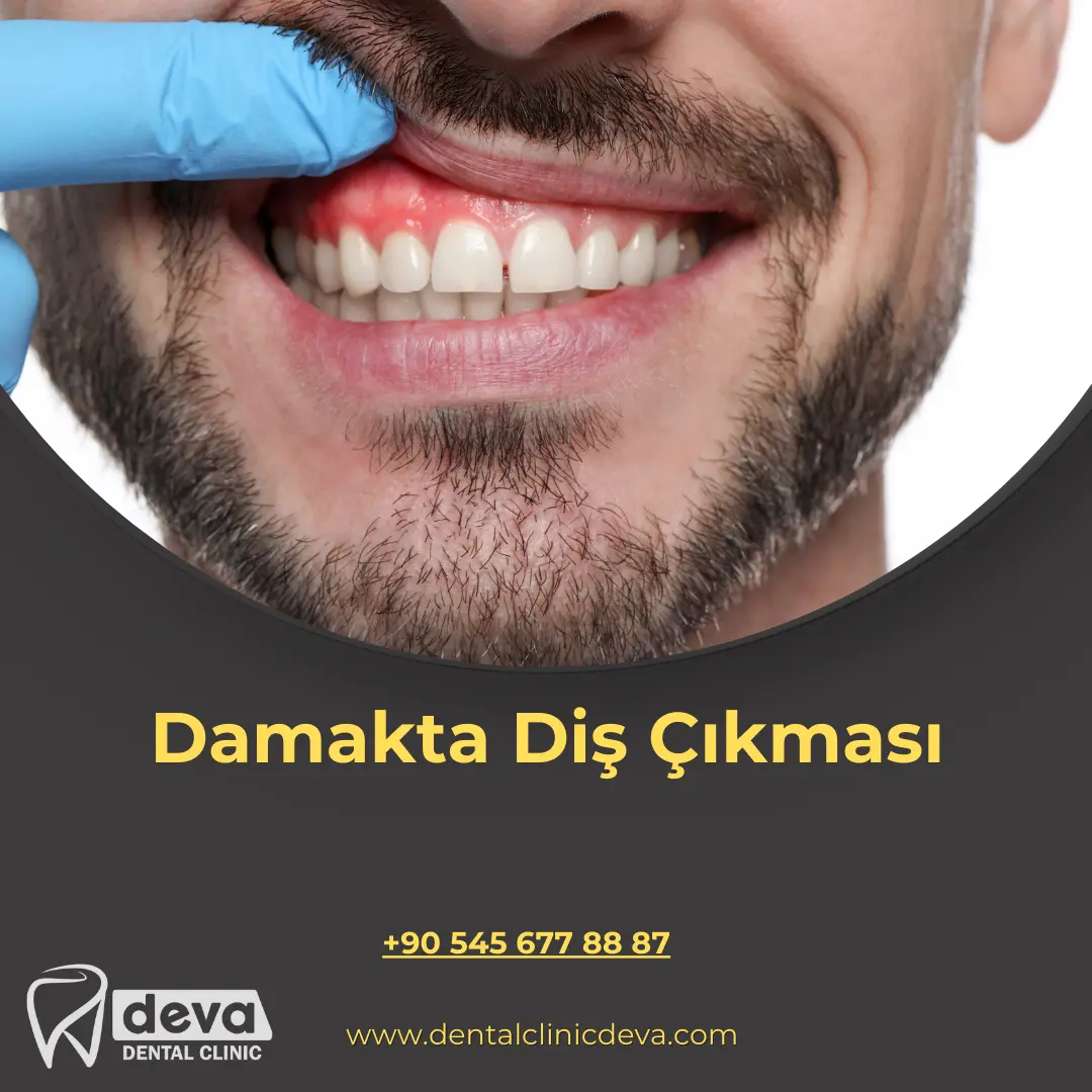 alveolit görüntüsü