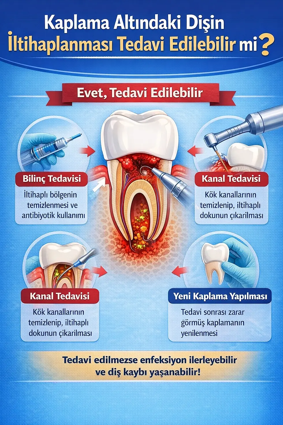 

Kaplama Altındaki Dişin İltihaplanması Tedavi 