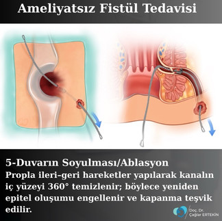  lazerle fistül ameliyatı fiyatları