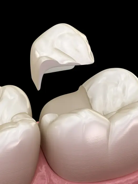 Bodrum Dolgu Tedavileri (Konservatif)