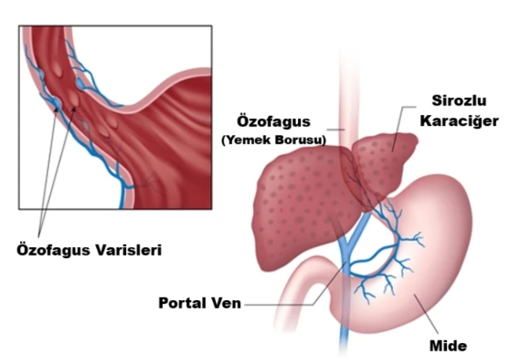 portal hipertansiyon nedenleri