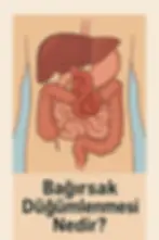 Bağırsak Düğümlenmesi Nedir