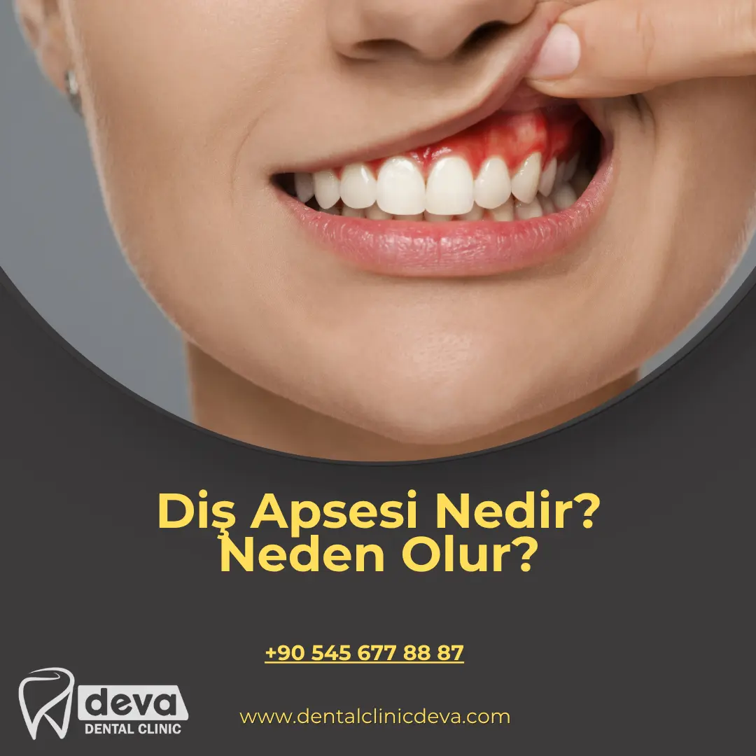kanal tedavisinden sonra su içilir mi
