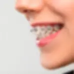 Bodrum Metal Diş Telleri