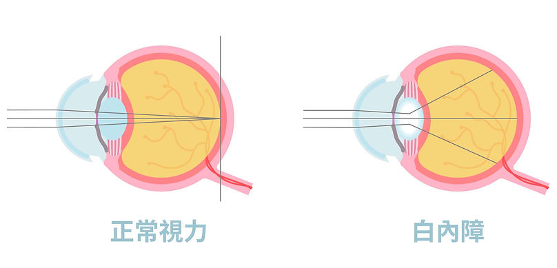 白內障簡介.jpg