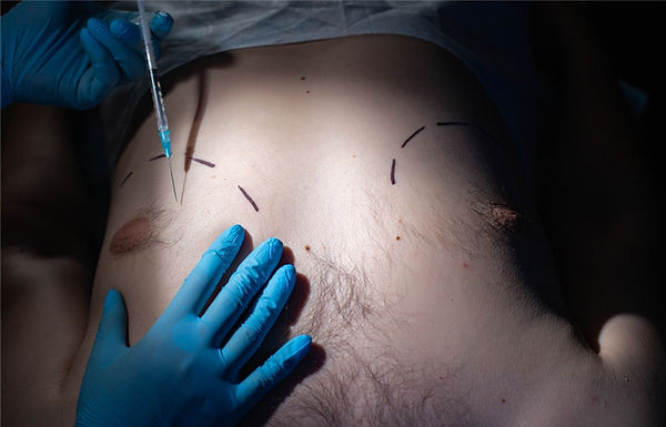 Male Breast Surgery.jpg