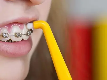 كيفية تنظيف الاسنان مع التقويم