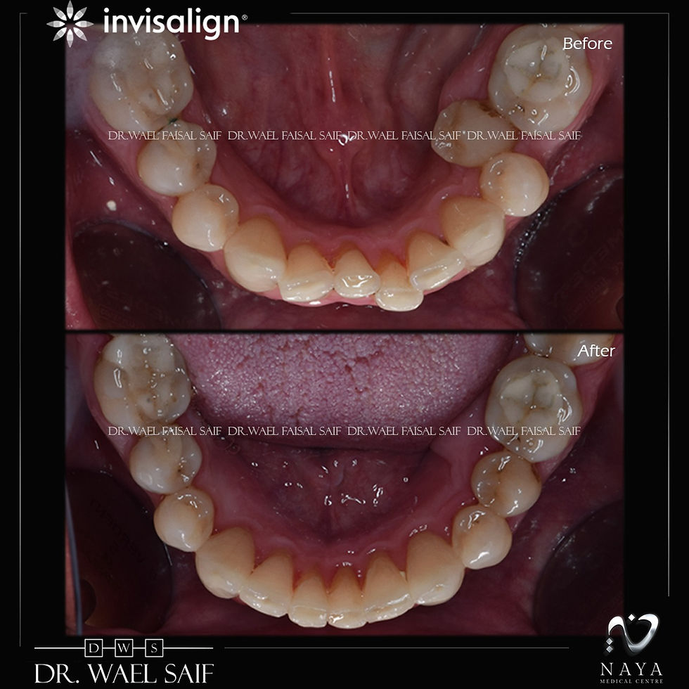 Invisalign Maintenance Tips: Daily Care Guide