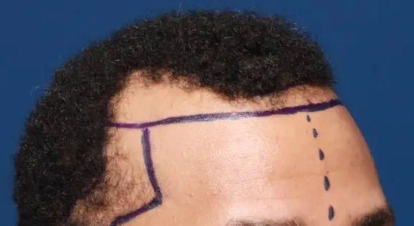 Hairline marked by a surgeon in preparation for a hair transplant procedure in Istanbul, Turkey.