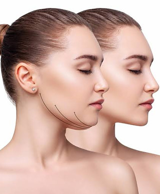 RF skin tightening