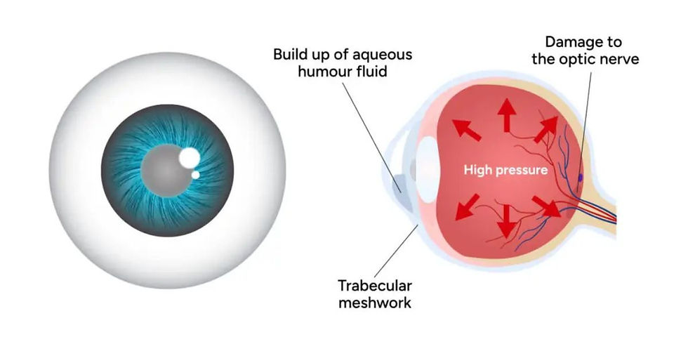 Glaucoma Treatment in Gurgaon
