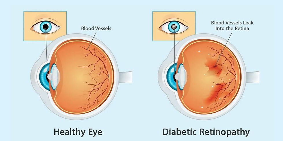 diabetic retinopathy