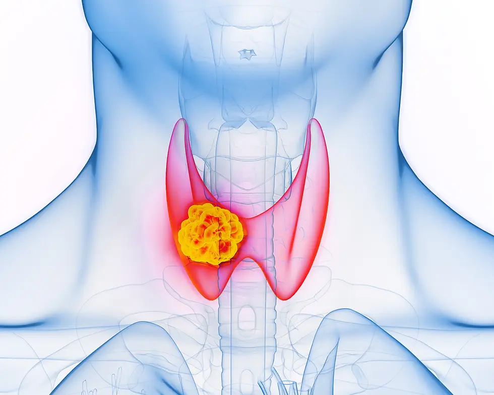Hashimoto Thyreoiditis und Schilddrüsenkrebs