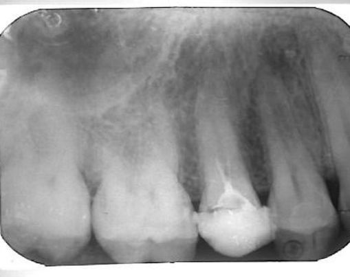 טיפול שורש בשן עם מורפולוגיה חריגה