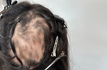 custom healthy safe hair loss solutions