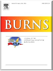 burns.jpg