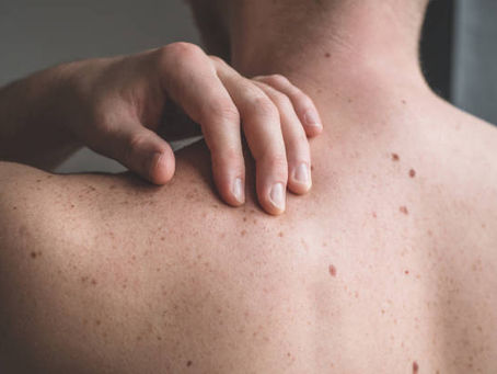 Understanding Benign Skin Lesions — and When to Be Concerned