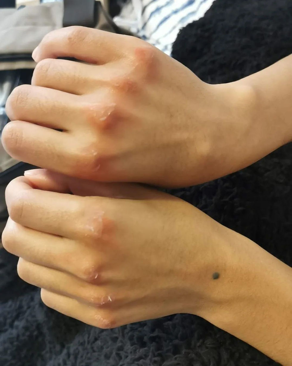 Red Raw Hand With Peeling Skin